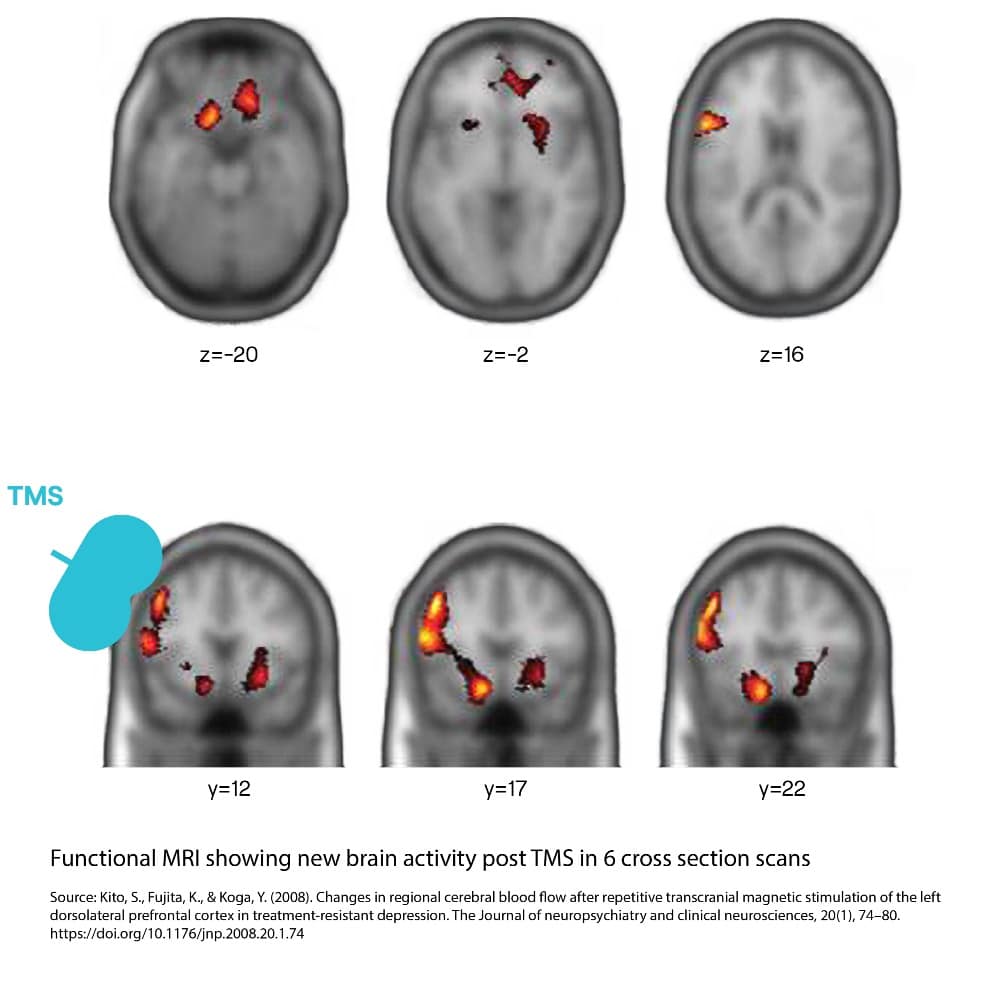 Transcranial Magnetic Stimulation brain scan