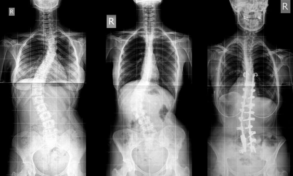 When-does-scoliosis-require-surgery
