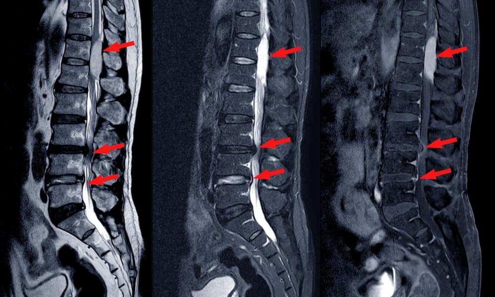 Spinal-stenosis-symptoms-to-be-aware-of