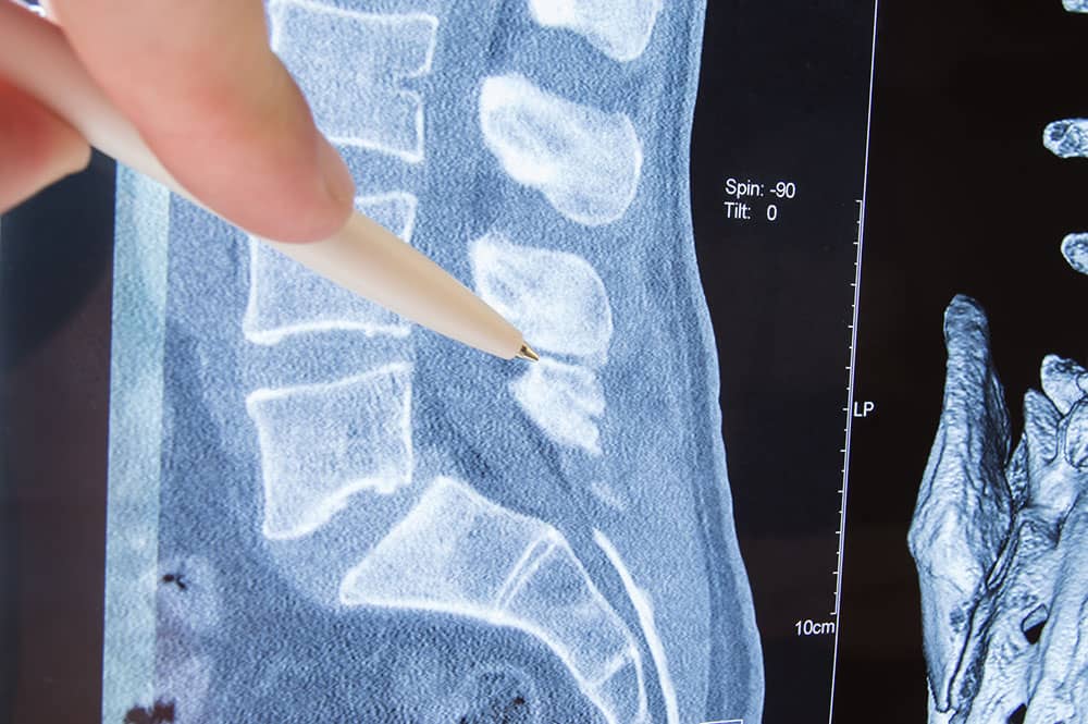 Recognizing Thoracic Spine Myelopathy - Texas Back Institute