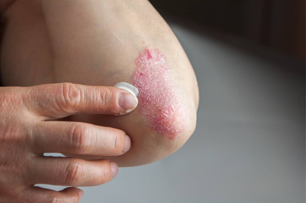 Psoriasis-awareness-month-tips-and-facts