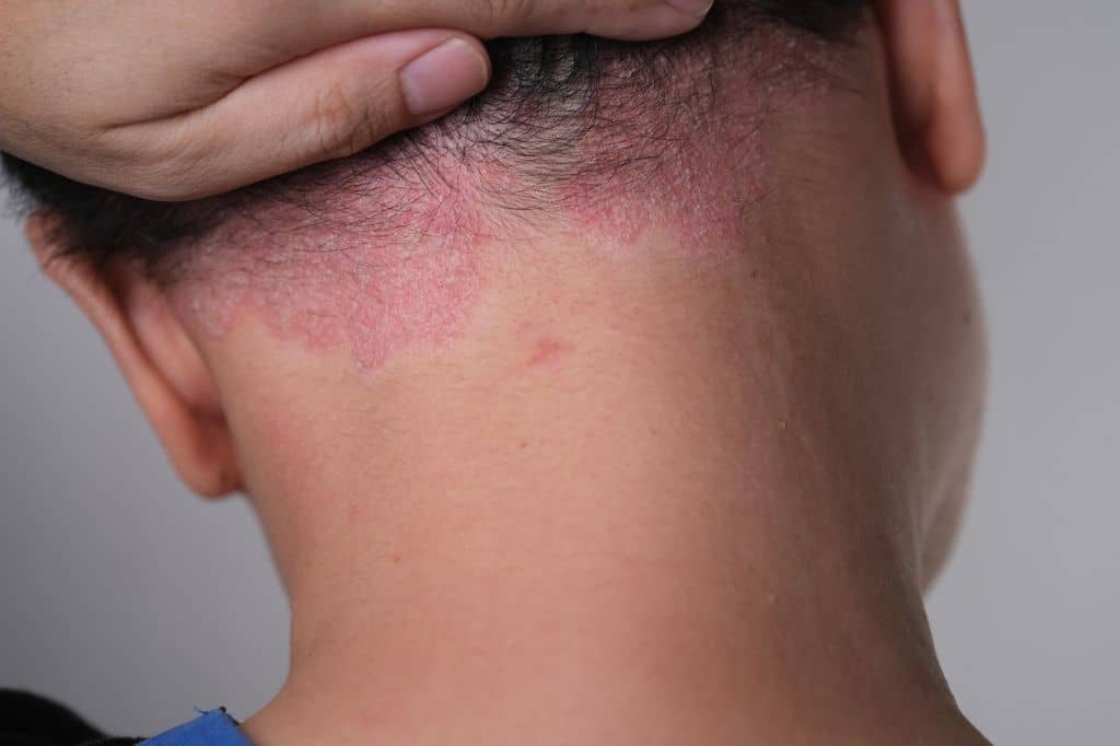 Scalp-psoriasis-what-you-need-to-know-and-how-to-find-relief