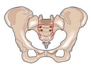 Outpatient Treatment for Osteoporotic Pelvic Fractures - The Orthopaedic  Institute