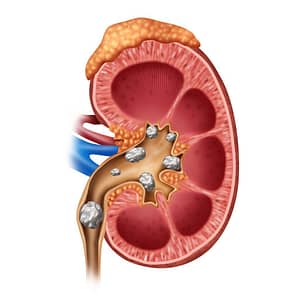 Kidney Stone Illustration