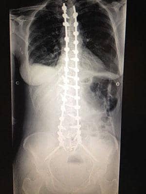 spine x-ray