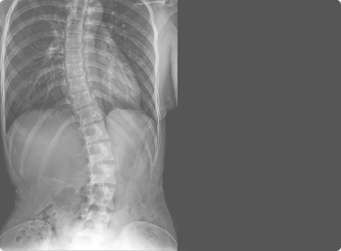 Scoliosis