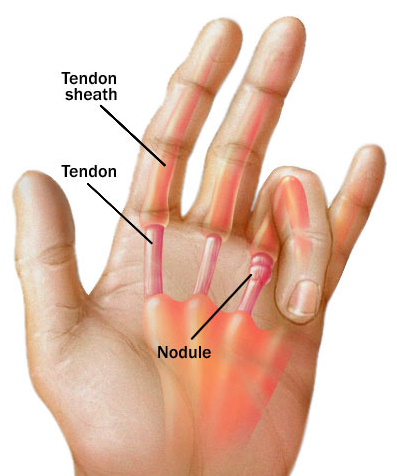 Trigger Finger Treatment | How It Affects Golf Players