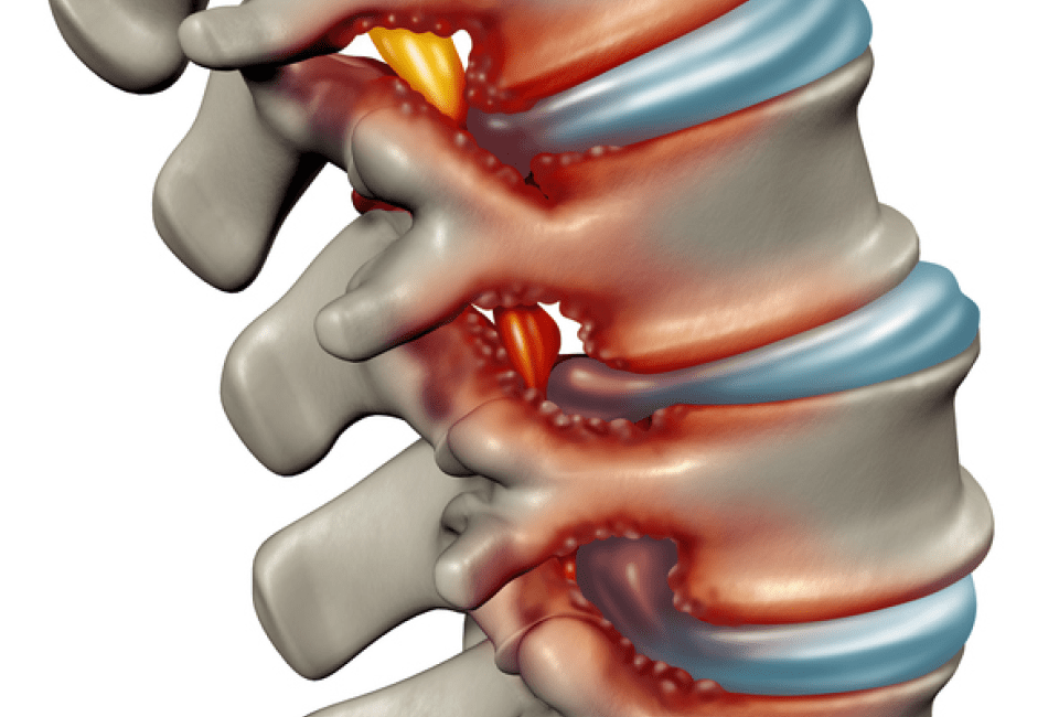 Graphic Of A Spine Showing Foraminal Stenosis