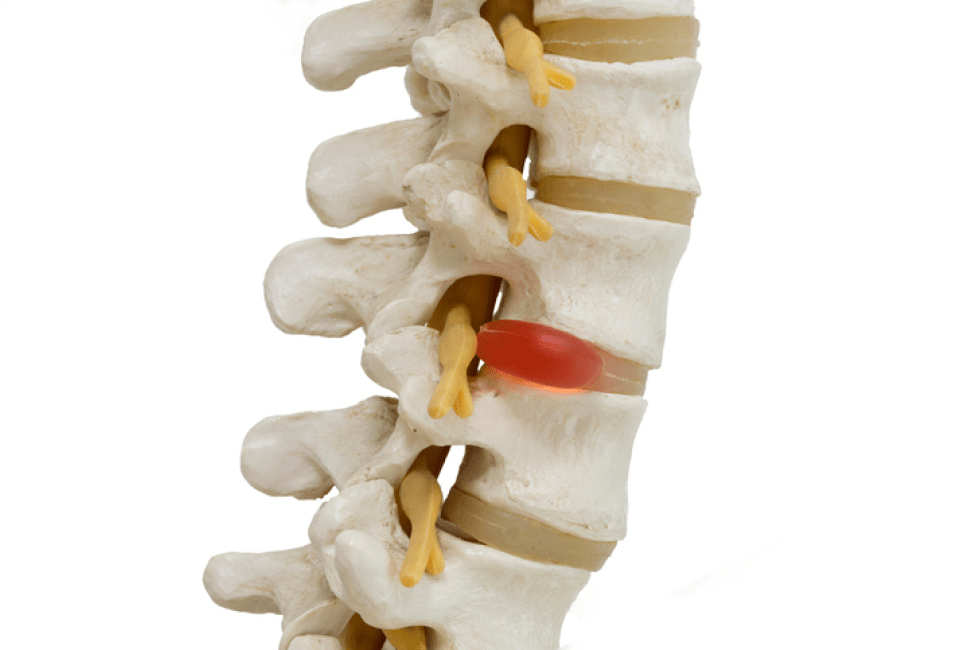 Herniated Discs