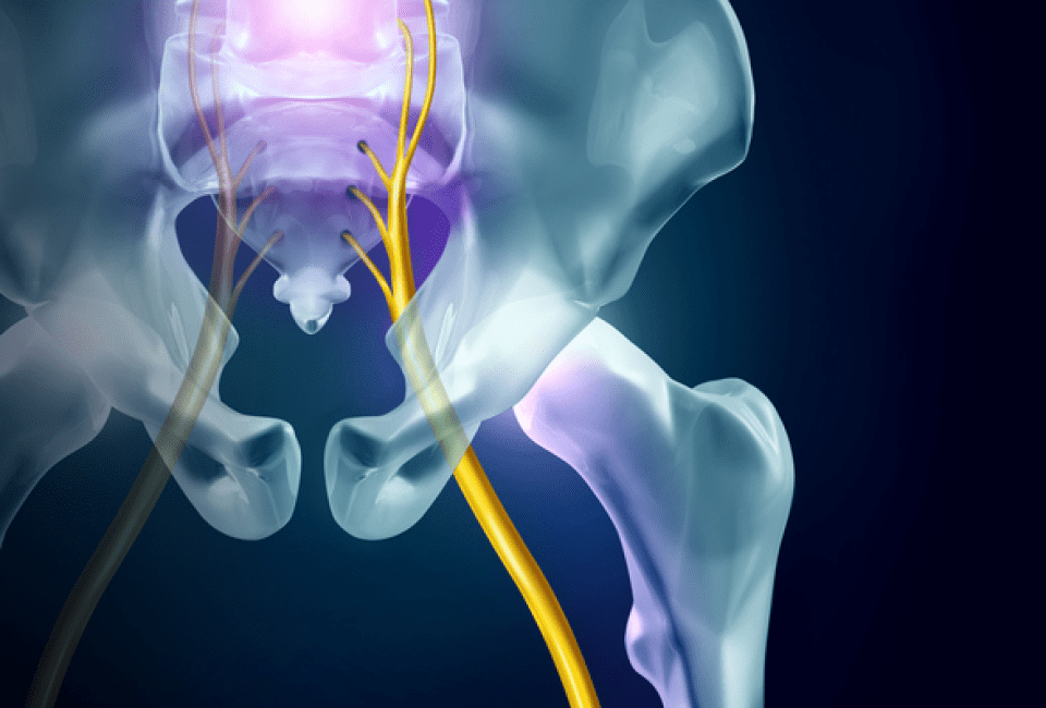 5 Tricks to Beat Your Sciatica Without PainKillers - Hooman Melamed, MD -  The Spine Pro