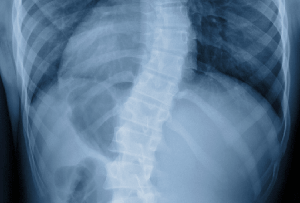 Scoliosis