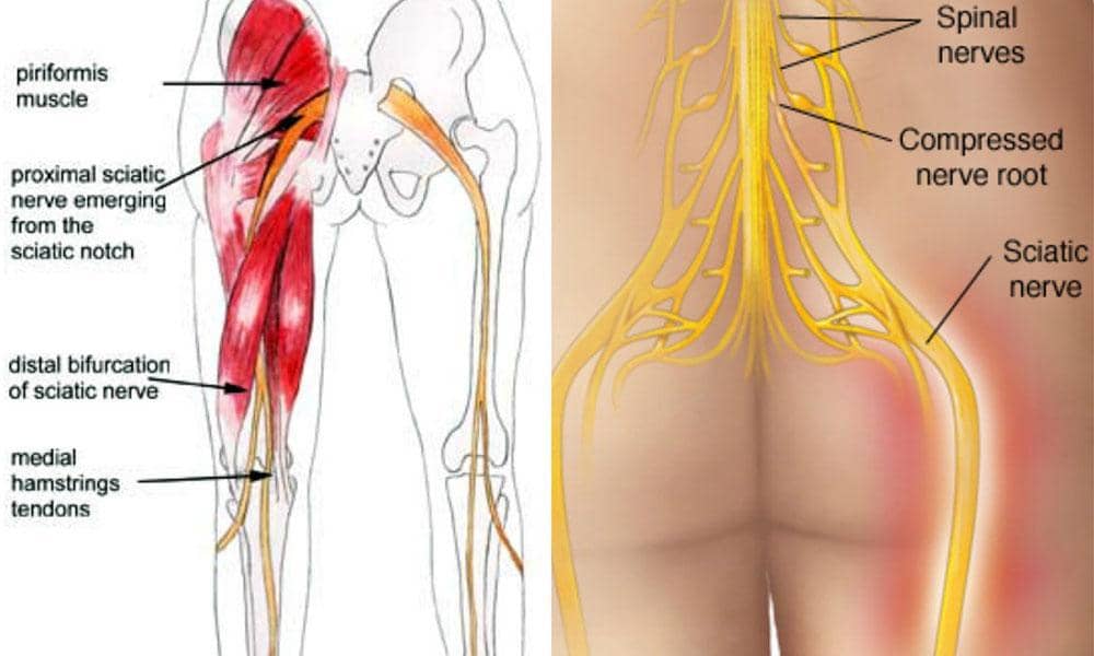 5 Tricks to Beat Your Sciatica Without PainKillers - Hooman Melamed, MD -  The Spine Pro