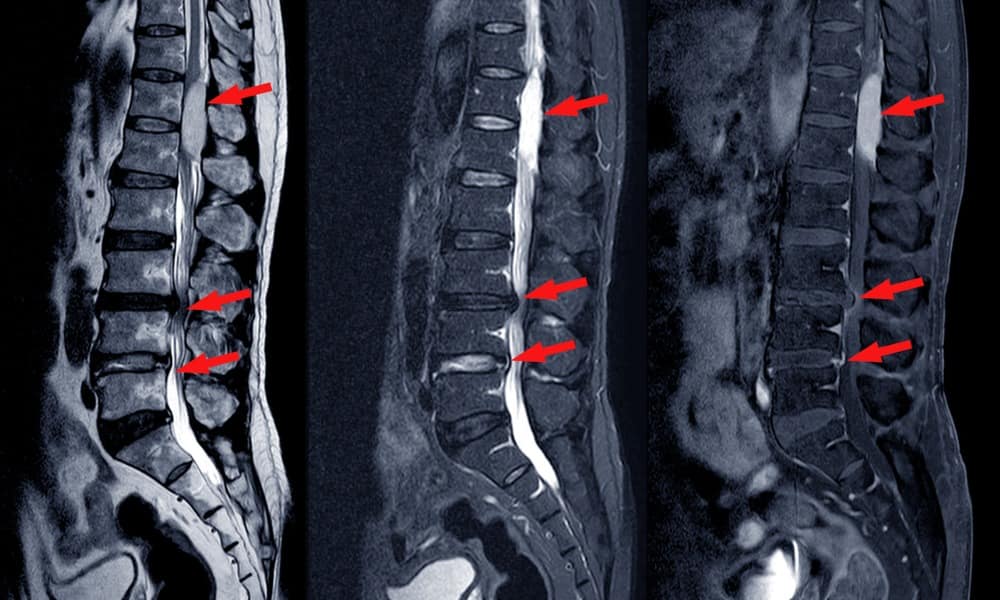 Spinal Stenosis Symptoms to Be Aware of Hooman Melamed, MD The